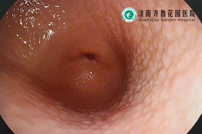 胃镜室肠镜检查发现一例鸡皮样胃炎