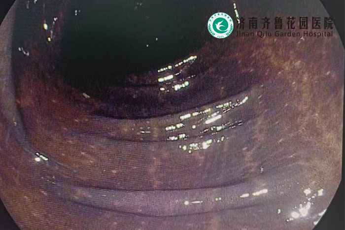胃镜室肠镜检查发现一例结肠黑变病
