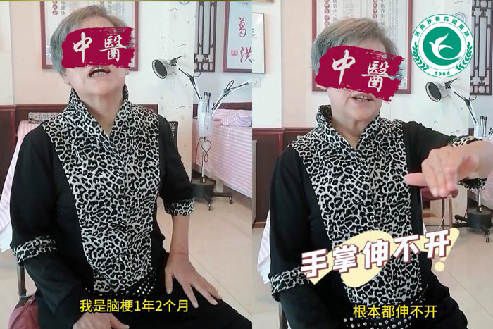 脑梗1年2个月针灸治疗一次后效果显著
