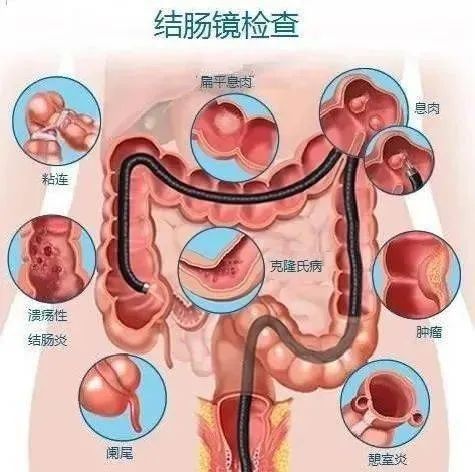 结肠镜检查能检查发现哪些问题