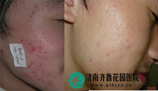 ��³��԰ҽԺƤ�����������ӡ��һ���Ƴ̺��Ч��