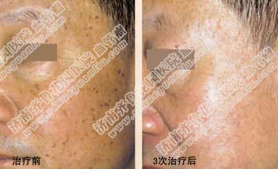 ���������ʲô�����Ƚϱ��ˣ��õ�Q����ȥ������������ѡ�񣬵�Q���ⲻ���ܹ��������Ƥ����֯�ڶ���ĺ���ϸ������û�и����ã������Ƴ̸��̣�ȥ������߸���ȫ�����̺ۺͺ���֢��