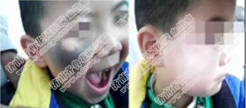 С�����ϵ�̫�����εú���˫����Ⱦ�ϼ��⹤��վ����ǰ�ļ������ȫ�ɿ����ܹ��������̫���룬�������̷ǳ���ȫ���ü���ȥ����̥��̫������ȻЧ���ܺã���ҲҪѡ������רҵ��ҽԺ��