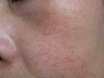 治疗红血丝要多少钱,双波长染料激光工作站是治疗红血丝等血管性疾病效果最好的医疗设备,联合我院其他先进技术综合治疗红血丝的效果更好,更安全,更实惠。