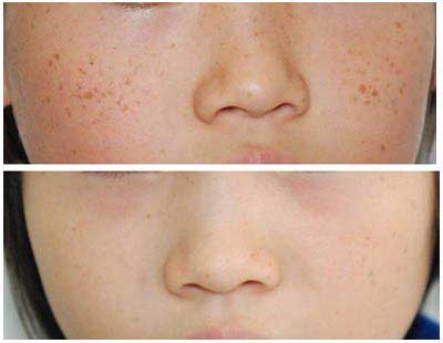 ������ȸ�ߵ�Ч���ò��ã���Ժ����ȸ�߲��õļ����豸��Ŀǰ��Ϊ�Ƚ���һ�ֵ�Q���������ǣ�����ȸ�����ѡ�񼤹�����ҩ����ۺ��Ʒ������ǲ�������ȸ�ߵ�Ч������������ƽ�ۺ�����ȫ��