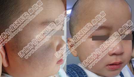 ��ׯѦ����������̫����õ�ҽԺ��̫����ֻҪ�öԷ������ܹ������κò����̺۵ģ�˫����Ⱦ�ϼ��⹤��վ����̫��������ף��ܹ��������Ƥ����֯�ڵĺ���ϸ�����ž�������