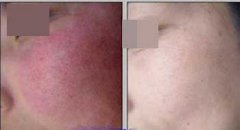 ��ׯỳ���ȥ����Ѫ˿�õ�ҽԺ���ĸ�