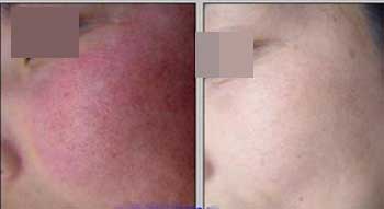 ��ׯỳ���ȥ����Ѫ˿�õ�ҽԺ���ĸ���������ŵ��˫����Ⱦ�ϼ��⹤��վ�������㣬ȥ����Ѫ˿�Ĺ�����ʹ�࣬���߲����ȥ����Ѫ˿���ѡ������רҵ��ҽԺ��