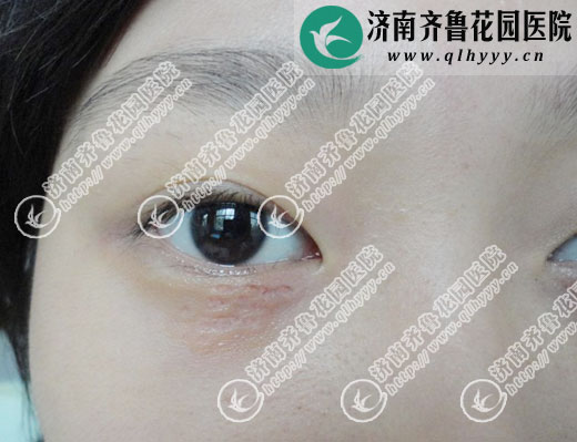 ͼ������Ƥ�µĺ������ڼ�����³��԰ҽԺƤ�����ü�������ʱ�ļ��̷�Ӧ