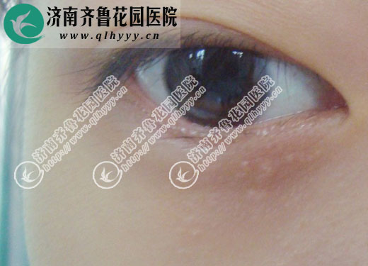 ͼ������Ƥ�µĺ������ڼ�����³��԰ҽԺƤ�����ü�������һ�κ�Ļָ����