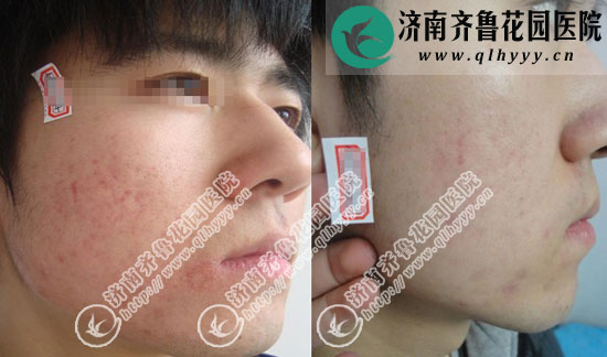 ðî´¯°¼¿Ó»¼Õß×ó²àÁ³ÓõãÕ󼤹âÖÎÁÆÇ°ºó¶Ô±ÈÕÕÆ¬