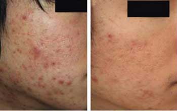 睡眠不好容易遭受成人痘的侵扰吗,混合性肌肤出现成人痘的几率比较大,如果该睡觉的时候不睡觉,皮肤就会分泌大量油脂继续工作,容易引发成人痘,我院治疗成人痘采用的是内调外。