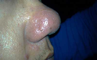 压力太大过于焦虑容易患上酒糟鼻吗,我院治疗酒糟鼻采用综合疗法内调外治,治疗后不留疤会缩小毛孔,预防酒糟鼻最好是保持心情平和舒畅,要及时排泄皮肤和心理上的不洁物。