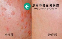 ��ƽ���֢״���ּ��Ƿ�����º�ӡ