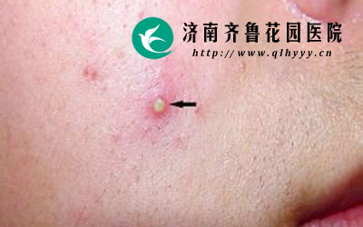 疖就是最常见的一种化脓性皮肤病,主要是因为某一个毛囊所属的皮脂腺发生炎症导致的,全身各处均可发病,尤其好生长于青少年人群中,那么,面部长有疖应该怎么办呢。