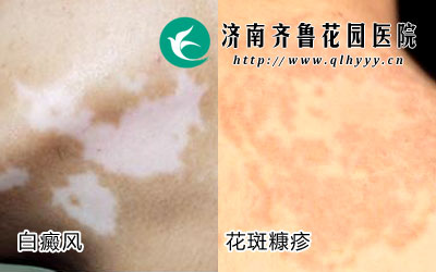 ��ҽԺƤ����Ҳ����������Щ���߻Ὣ���߿���Ͱ���������ֲ�������֮����ʲô��ͬ��������ü�����³��԰ҽԺƤ����ר���ŬB���θ������ǣ����߿���Ͱ������������Щ��