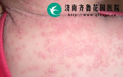 引起小儿荨麻疹的因素有很多比如天气的原因冷热交替太快,还有食物引起过敏等都会引发荨麻疹。