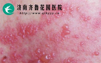 带状疱疹是由水痘带状疱疹引起的病毒性皮肤病,对人体的危害非常大,严重者还会危及到生命。