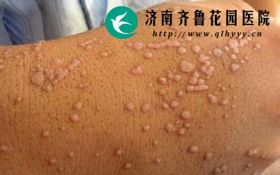 扁平疣的危害很大会引起癌变一定要到正规的医院检查治疗。