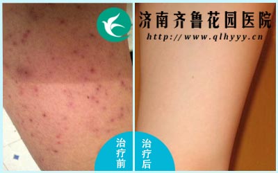 ����ë���׵�ԭ���кܶ��п������Ŵ����أ�Ŀǰ�������ݼ���������ë������õķ�����