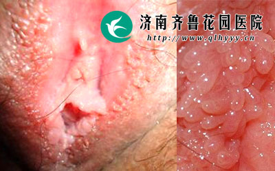 皮肤科专家指出外阴上为什么会长有肉色疙瘩,一般是在不洁的性生活之后出现的,这有可能是尖锐湿疣,尖锐湿疣属于性传播疾病的一种,此病易复发。