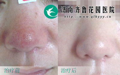 ���������Ӱ���沿���ۣ���ˣ��������ּ���ǧ��Ҫ���⣬��ô������ǵ��γ�ԭ��֢״����Щ�أ�һ�����˾�����������κá�