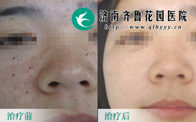 雀斑不仅对外观容貌产生很大的影响,还会严重影响患者的心理健康,尤其是那些对于面子形象很在意的人群,那么,长了雀斑应该怎么治疗呢,雀斑能去掉吗。