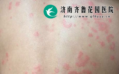 ݡ�����Ǻܶ����һ�ֹ�����Ƥ������������������ݡ���������Ҫ��֢״���֣���Ҳ�Ǻܶ�ݡ������޷����ܵģ���ô��ݡ����߸���ô�����������ء�