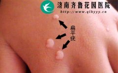 ��ƽ�໼���������ڼ�Ӧ��ע��ʲô