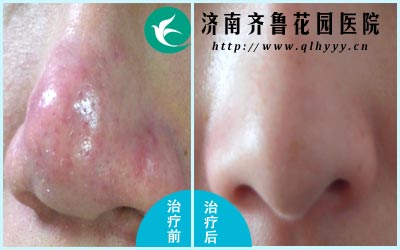 酒渣鼻分为三期,严重影响人们的美观,二期只用一种方法很难彻底治好酒渣鼻。