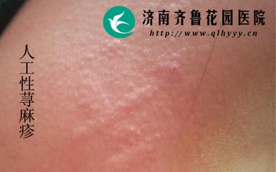 人工性荨麻疹也称为皮肤划痕荨麻疹。
