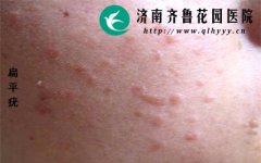 ��ƽ�໼��Ӧ��λ���Ƥ��