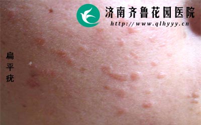 ��ƽ�໼�������ƹ�����Ҫע���ɹ��Ҫ˽������ҩ�