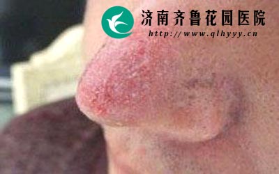 济南齐鲁花园医院常年有知名专家坐诊能很好的治疗酒渣鼻。