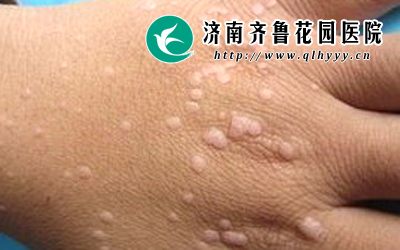 刘先生今年26岁,在一年前手上就长了一些小肉粒,平时不疼也不痒的,没有任何的症状表现,请问这是扁平疣吗,扁平疣的治疗方法有什么呢。