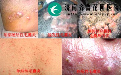 毛囊炎有很多类型常见的有脓疮性毛囊炎和单纯性毛囊炎等。