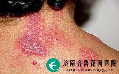 Ů�Ի��˴�״�����е���΢����ʹ��