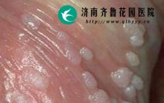 ���˼���ʪ��Ӧ��ע��ʲô