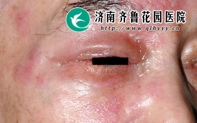 面部带状疱疹也叫做水痘带状疱疹病毒,带状疱疹一旦侵犯到三叉神经眼支,一旦不及时治疗就会对身体产生严重的危害,那么,面部带状疱疹会导致失明吗。