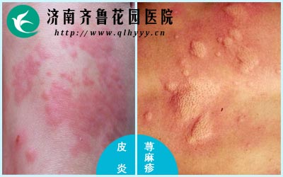 Ƥ�׵������̶�Ҫ��ݡ�������ء�