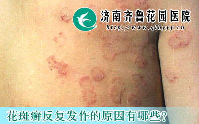 ����Ѣ����������ԭ����ʲô������ѢҲ�������ǳ�˵�ĺ��ߣ�Ҳ�������߿������Ѣ�Ĳ�����Ҫ���ܵ������Ⱦ����ģ�������һ���Ĵ�Ⱦ�ԡ�