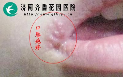 疱疹是由病毒感染所致的具有一定的传染性。