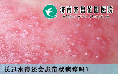 水痘和带状疱疹是同一种病吗,水痘和带状疱疹是同一种病毒引起的,但是却是两种不同的疾病,那么,长过水痘还会患带状疱疹吗。