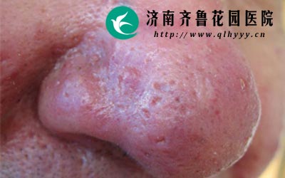 长期食用辛辣刺激性的食物会引发酒渣鼻。