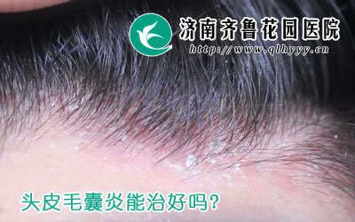 ͷƤë�������κ���ë���׵�Σ������Щ��ë���׿�������ܶಿλ������������ͷ��������ͷƤë���׵�֢״�����������У�ŧ�������׵ȡ�