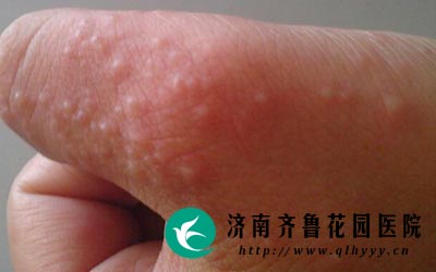 ������÷��ڽ��漾�ڲ�ͬ�̶ȵĳ���������֢״��