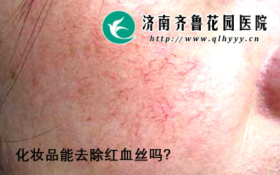 ��Ѫ˿��Ȼ��һ�ֺܳ��������󣬵��ǶԻ������ѵ���ò���۲�����Ӱ��ܴ���ô����Ѫ˿���γ�ԭ����ʲô�أ���ױƷ��ȥ����Ѫ˿��