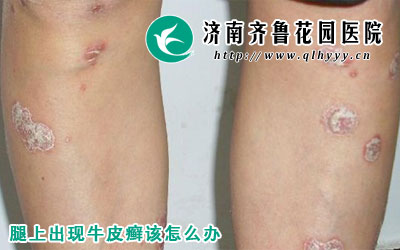 ţƤѢ��������Ӱ�컼�����ۣ����һ��ᵼ�»���������ֺܶಢ��֢�����ţƤѢ�����ƺܶ໼�߶���֪����ô�죬��ô�����׳�ţƤѢ��ô���ء�