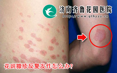 花斑糠疹反复发作怎么办,对于花斑糠疹的诊断可采用真菌检查确诊,在治疗上,花斑糠疹患者只要按着医生的指导进行治疗就一定能取得很好的效果,