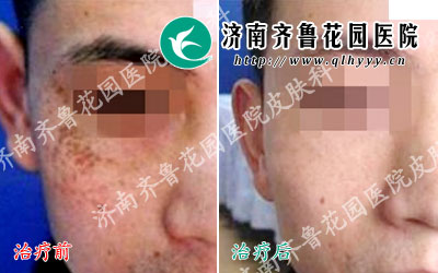 小刘,25岁,职业为一名摄影师,从出生后右脸颊就长有太田痣,那么,太田痣怎么才能治好吗,激光去除太田痣怎么样。